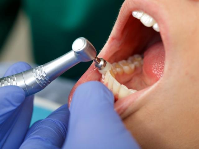 Pose d'un implant dentaire