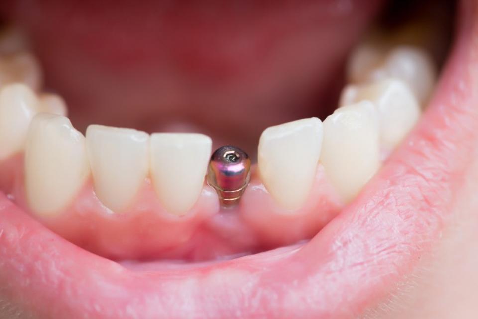 Pose d'un implant dentaire